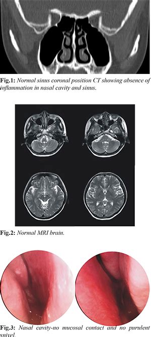 Encephalitis with Anterior Ethmoidal Neuralgia