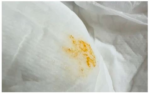 Whole Exome Sequencing Facilitates Early Diagnosis of Lesch–Nyhan ...