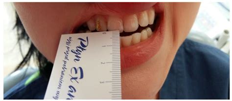 Diagnostic of Temporomandibular Disorders and Other Facial Pain Conditions—Narrative Review and ...