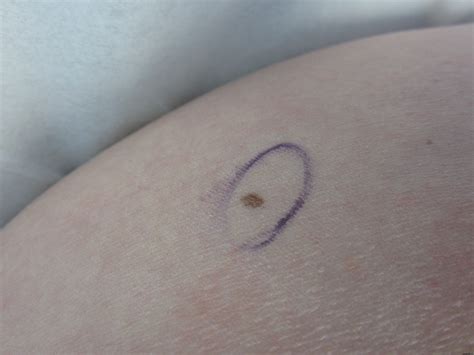 Are Moles On Dogs Cancerous