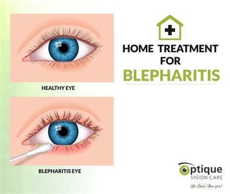 Bildergebnis für blepharitis hausmittel