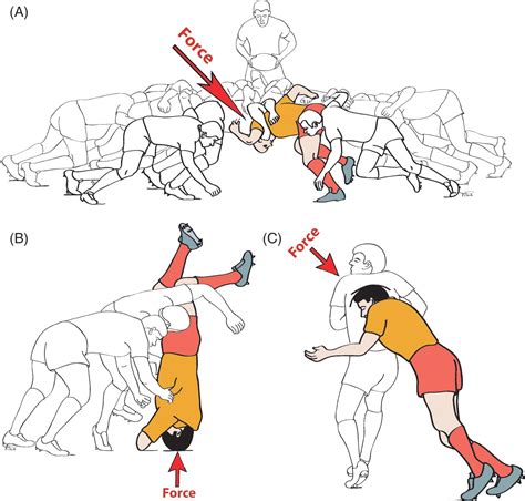 Mechanisms of cervical spine injury in rugby union: is it premature to ...