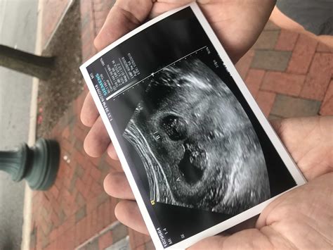 9 Weeks Pregnant with Twins: Tips, Advice & How to Prep | Twiniversity ...