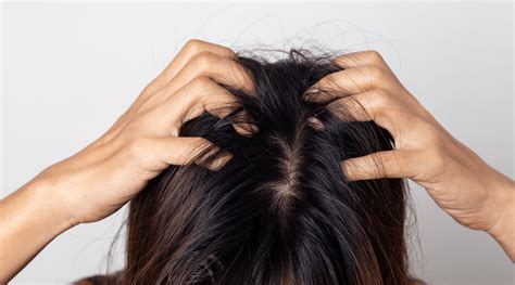 A Guide to Scalp Psoriasis – Oleum Cottage