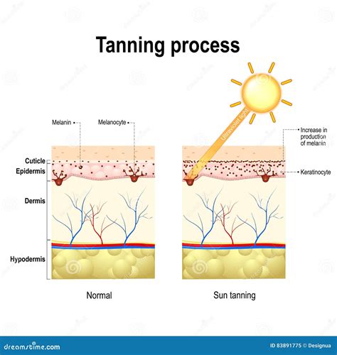 Melanin Production. Illustration Showing Colour Human Skin Affect From UV Rays The Cause ...
