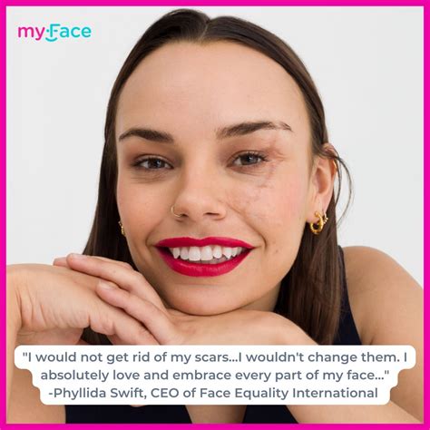 myFace on LinkedIn: #myfacemystory #faceequality #craniofacial # ...