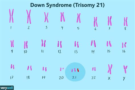 Down Syndrome Causes Chromosome at Petra Martin blog