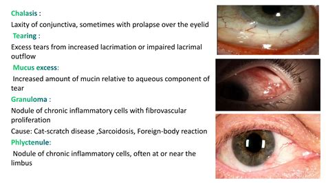 anatomy of conjunctiva. Ophthalmology slides | PPTX