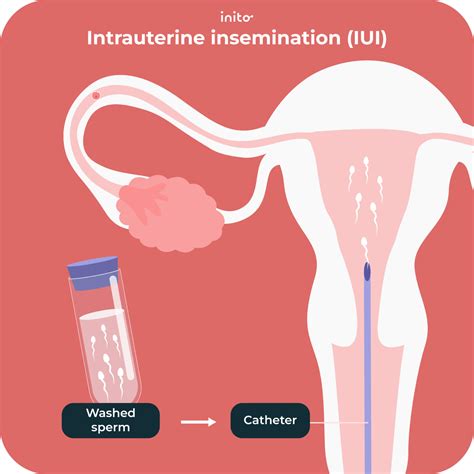 How Is IUI Procedure Done 的图像结果