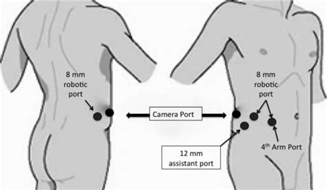 Image result for Robotic Retroperitoneal Partial Nephrectomy