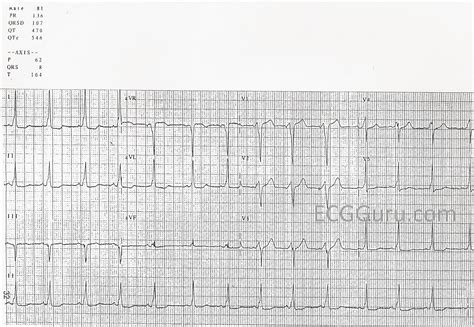 Wolff-Parkinson-White Syndrome | ECG Guru - Instructor Resources