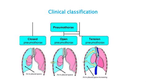 Classification Of Pneumothorax