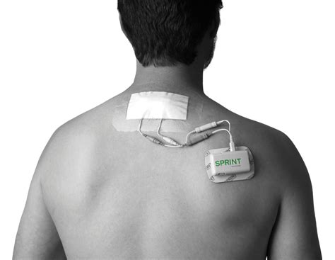 SPRINT PNS System brings Breakthrough Pain Relief
