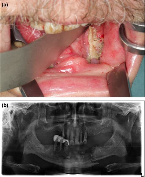 Osteoradionecrosis Of Jaw