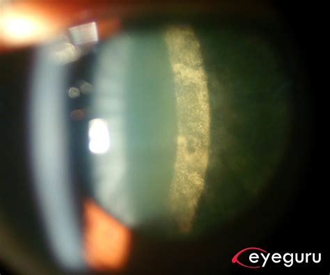 Posterior_Subcapsular_Cataract - EyeGuru