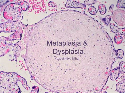 Metaplasia & Dysplasia | PPTX