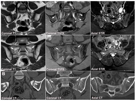 Normal Sacroiliac Joint Xray