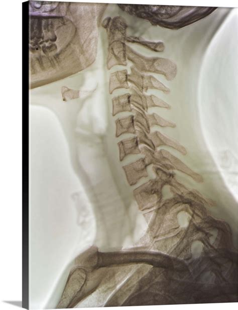 Normal neck, X-ray | Great Big Canvas