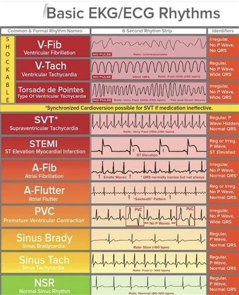 Image result for Synchronized Cardioversion EKG Strips Practice