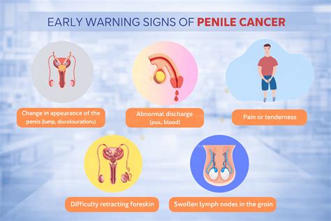 Penile Cancer | St. Stamford Modern Cancer Hospital Guangzhou