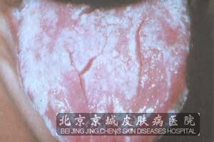 念珠菌病可以怎样诊断出_念珠菌病_北京京城皮肤医院(北京医保定点机构)