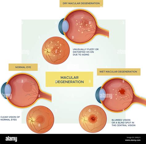 Normal Eyes vs Dry / Wet Macular Degeneration - Stock Illustration as EPS 10 File Stock Vector ...