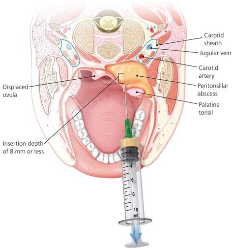 Peritonsillar abscess causes, signs, symptoms, diagnosis and treatment