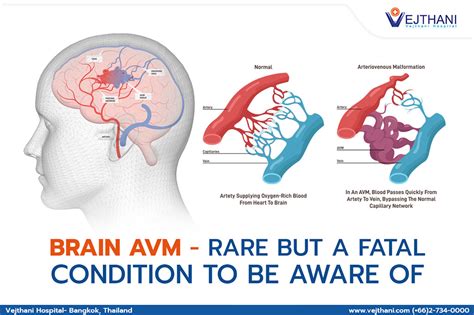 Brain Avm Arteriovenous Malformation Symptoms And