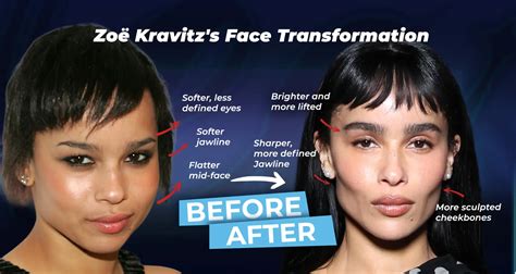 Zoe Kravitz Face Surgery