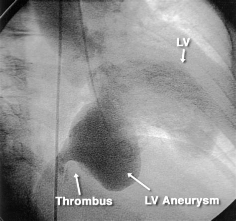 Massive Left Ventricular Aneurysm | Circulation