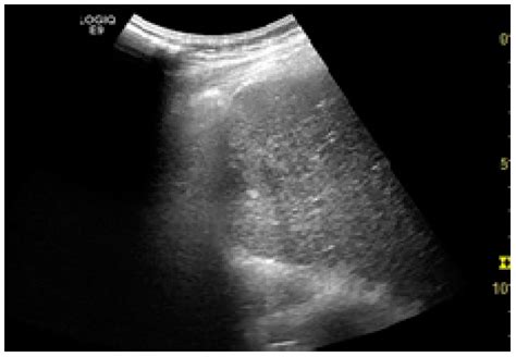 Liver Cancer Ultrasound