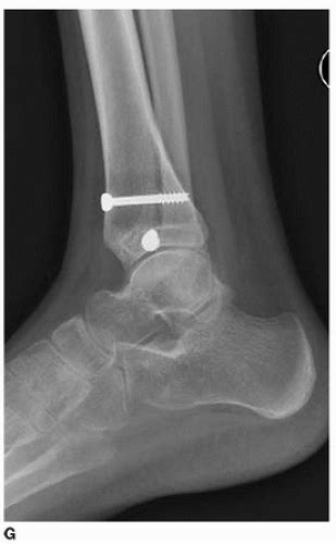 Transitional Ankle Fractures: Juvenile Tillaux and Triplane Fractures ...