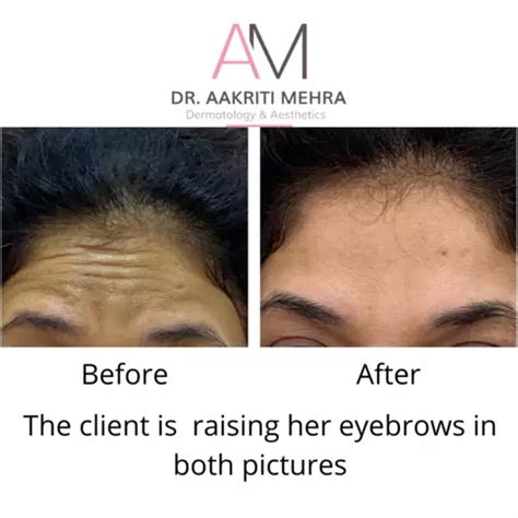 Best Botox Treatment in Mumbai with Latest Prices | Top Botox ...