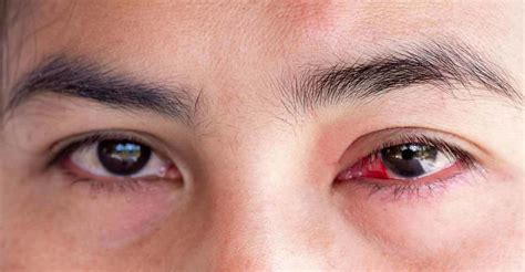 Conjunctivitis can spread from public pools too: Safety tips from doctor