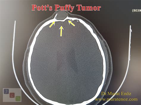 Pott's Puffy Tumour