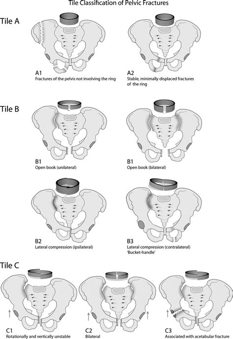 Pelvic fracture-related urethral and bladder injury | BMJ Military Health
