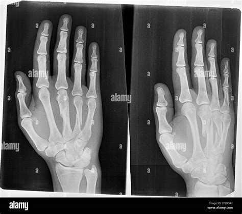 An x-ray showing a fracture of the 3rd and 4th metacarpal bones in the ...