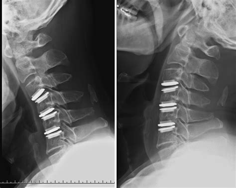 Image result for Disc Replacement Procedure