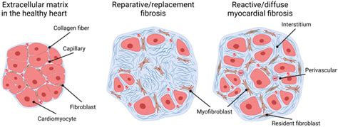 Non-Ischemic Myocardial Fibrosis in End-Stage Kidney Disease Patients ...