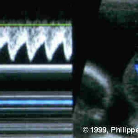 📃 Twin-reversed arterial perfusion syndrome (TRAP or Acardiac twin)