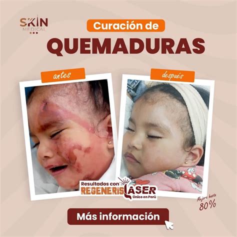 Quemadura Menor De Tercer Grado