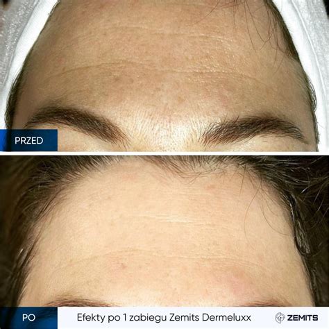 Urządzenie do dermabrazji wodnej i infuzji tlenowej Zemits Dermeluxx Pro kupić w Polsce