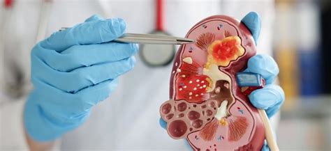 Revisión sobre la enfermedad renal crónica como factor de riesgo ...