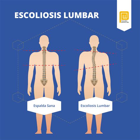 Descubre todo sobre la escoliosis: causas, síntomas y tratamiento