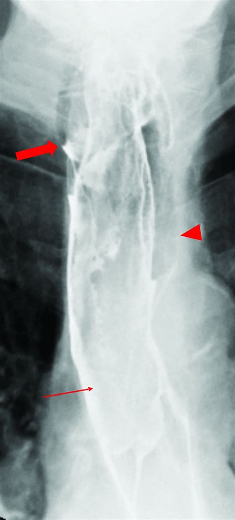 Large Recurrent Esophageal Fibrovascular Polyp | Applied Radiology