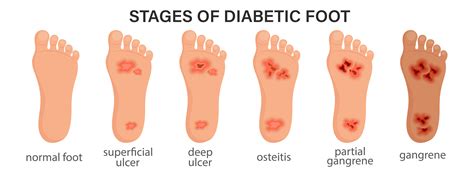 Diabetic Wound Care Specialist in Mumbai | Diabetic Foot Ulcer Treatment