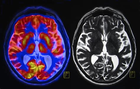 Invicro's Algorithm Quantifies Alzheimer's Amyloid Plaques in PET Scans