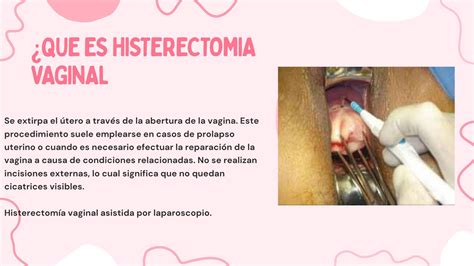 Histerectomia Vaginal Histerectomia (Retirada Do Útero) Dra. Maria
