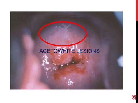 Does Colposcopy Hurt