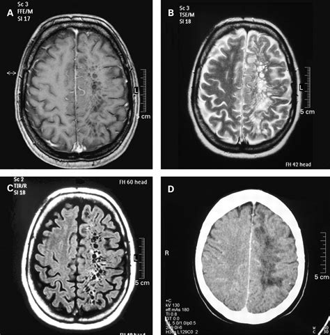 Extreme unilateral widening of Virchow–Robin spaces mimicking stroke | Journal of Neurology ...